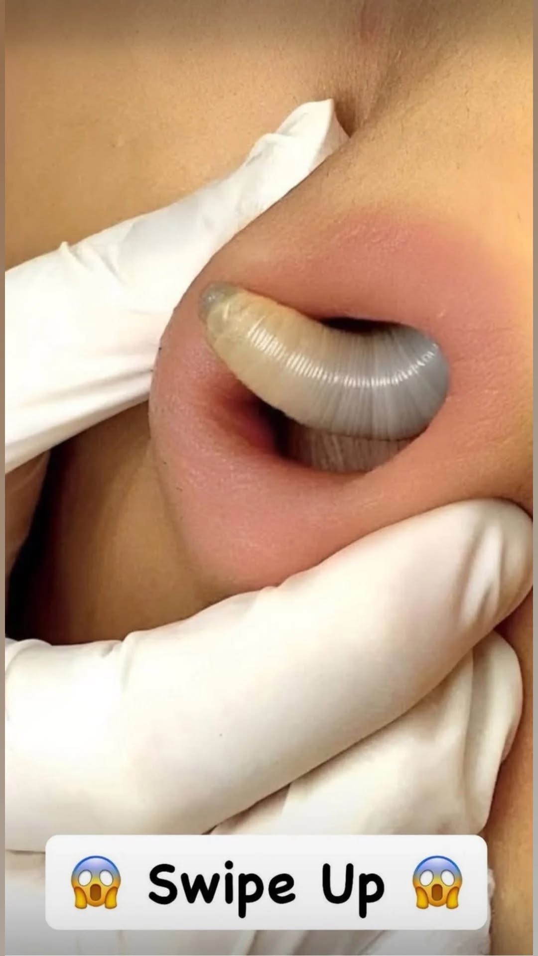 ST10. Why You Keep Getting Pimples Inside Your Nose, and What to Do About It