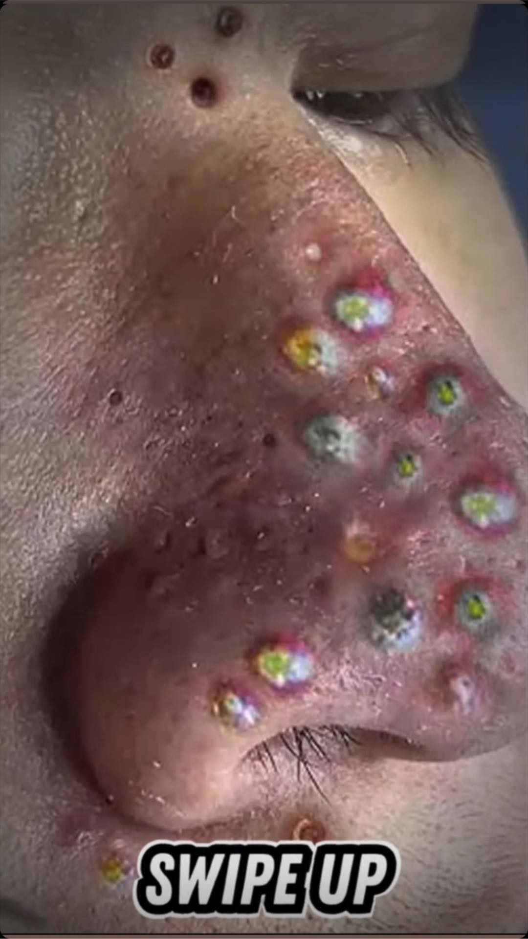 Their acne is severe