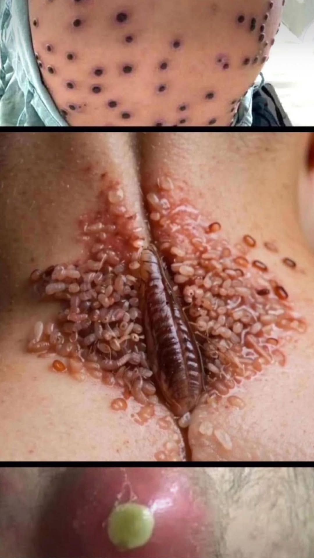 Their acne is severe