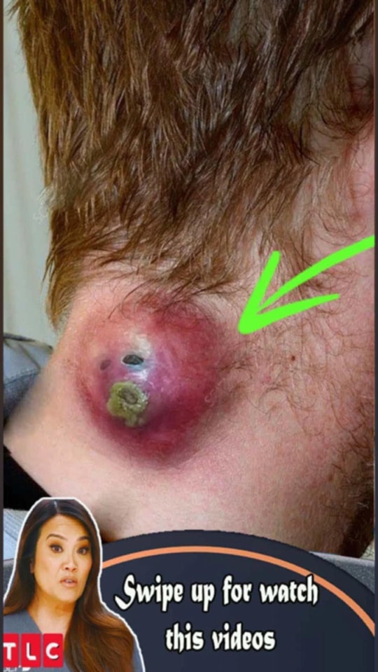 Acne And Everything You Need To Know About Them