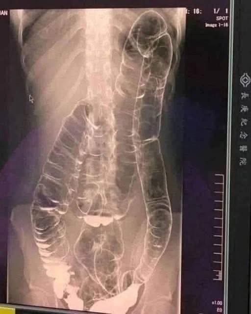 Severe Constipation and Toxic Megacolon: Causes and Solutions