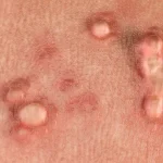 hpv-warts-722x406
