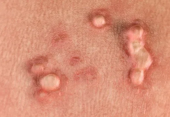hpv-warts-722x406