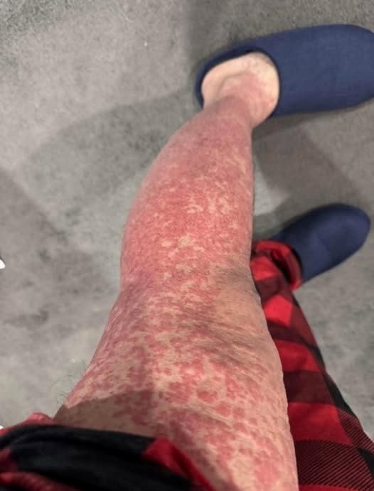 These Are the Consequences of Sleeping With Bed Bugs and Why a Rash Like This Can Happen in a Minority of People, How the Human Body Reacts to Repeated Bed Bug Exposure, What Is Actually Happening Under the Skin, and When This Reaction Becomes Serious