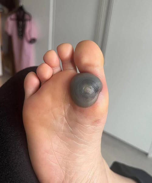 My daughter woke up with this huge spot on her foot. I don’t know what it could be. She’s been in pain and can’t move her foot. What is this? Explain this