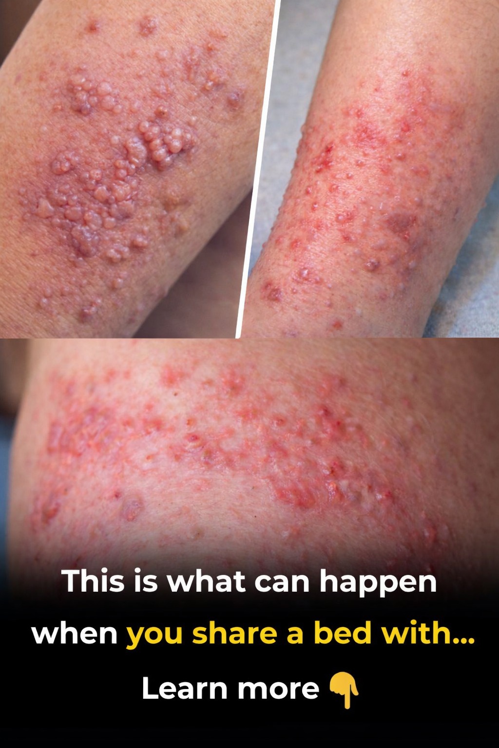 HPV in Men: Understanding the Silent Infection and How to Stay Protected