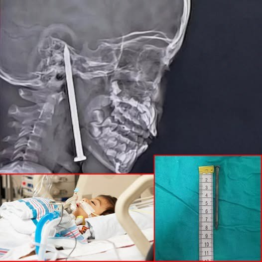 7-Year-Old Boy Gets 3-Inch Nail Lodged in His Brain in Freak Accident While Playing