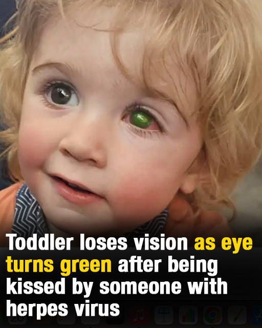 Toddler Goes Blind After a Simple Kiss Turns into a Tragic Incident