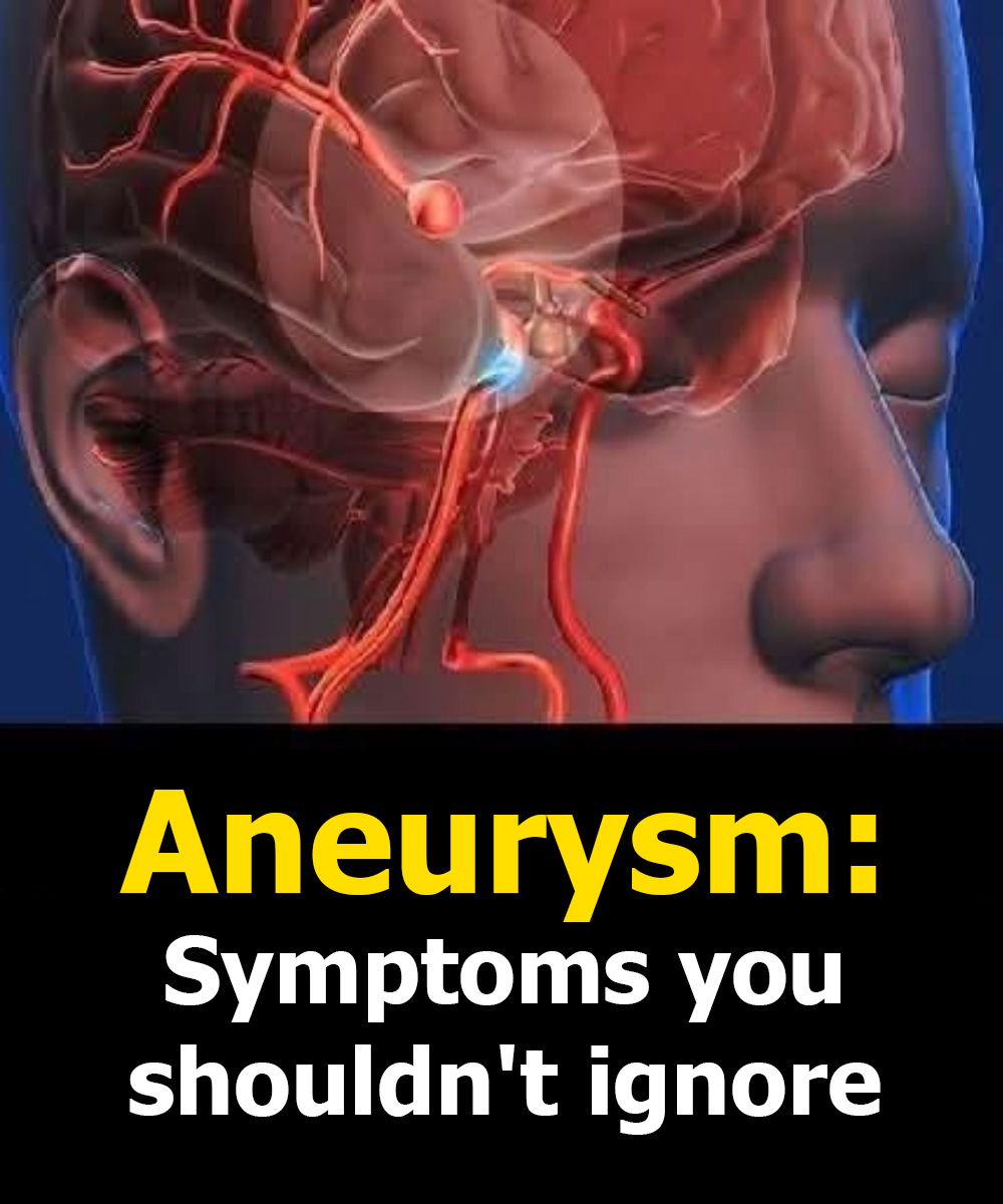 Aneurysm: Signs You Shouldn’t Ignore…