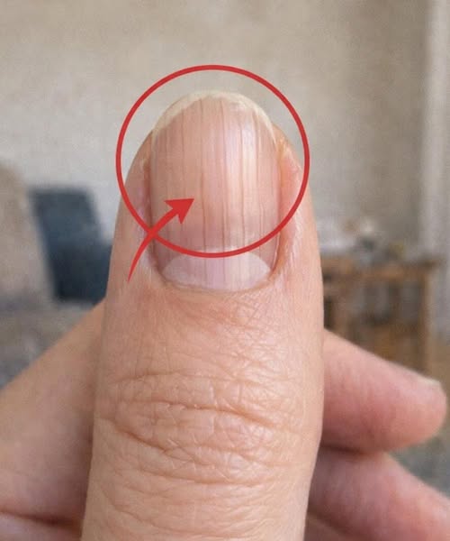 Doctor Uncovers A Telltale Sign In Your Fingernails That May Predict Your Life Expectancy