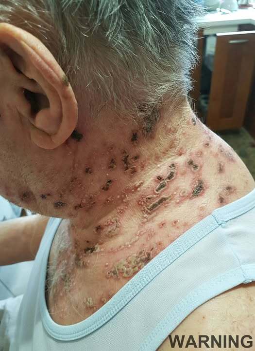 The Silent Virus Within: Understanding Shingles and How to Take Control of Your Health