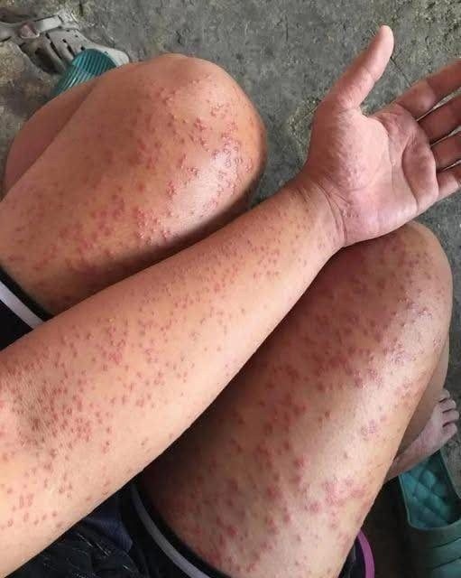 The Hidden Killer In Your Bed Why Waking Up With These Itchy Red Patches Is A High Stakes Medical Emergency That Could Shut Down Your Ability To Breathe In Minutes